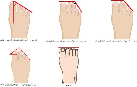پای ایرانیان چه شکلی است؟ + عکس