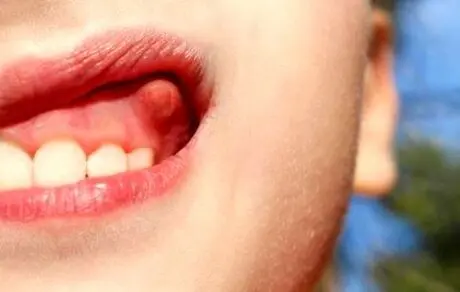 عفونت دندان چه بلای سرمان می‌آورد؟!