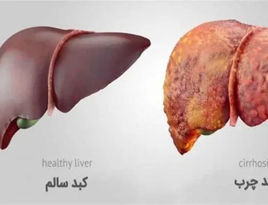 با کبد چرب خداحافظی کن! / ویدئو
