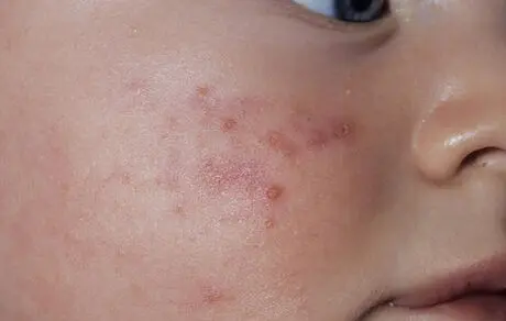 
چگونه جای جوش را از بین ببریم
