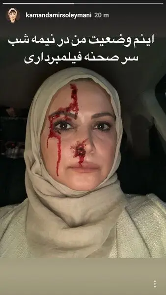 صورت زخمی و پُر از خون خانم بازیگر + عکس 