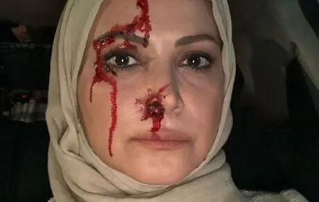 صورت زخمی و پُر از خون خانم بازیگر + عکس 