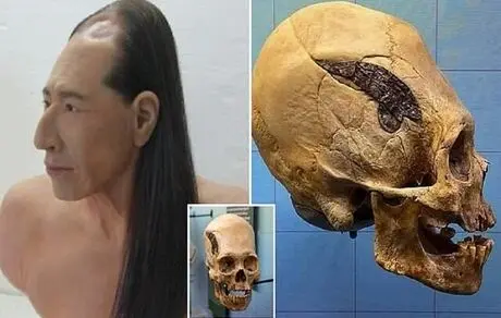 اولین جراحی جهان بر روی یک جنگجوی پرویی انجام شده است