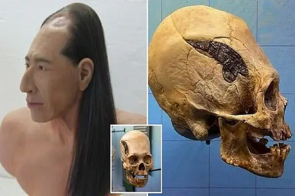 اولین جراحی جهان بر روی یک جنگجوی پرویی انجام شده است
