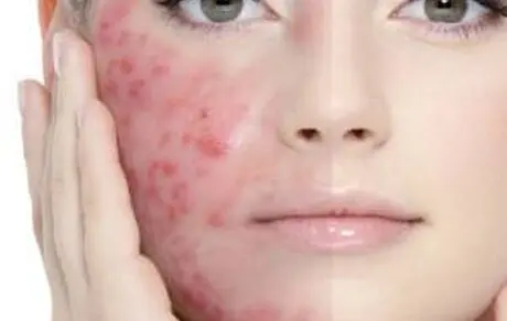 از بین بردن جوش ها با این بخور